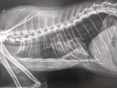 pectus excavatum - klatka lejkowata