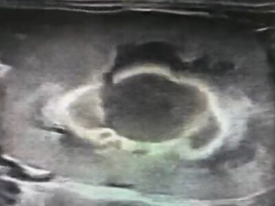 ultrasonographic medullary band sign i a cat