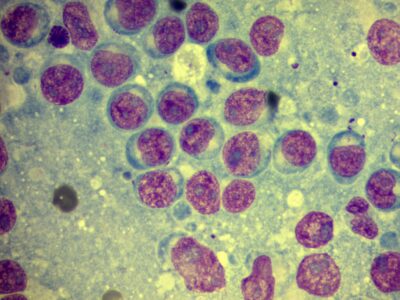 Biopsja z węzła chłonnego - chłoniak
