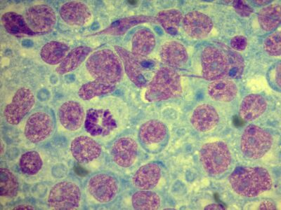 Biopsja z węzła chłonnego - 